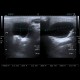 Branchial cleft cyst, parotid gland: US - Ultrasound